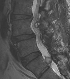 Spine Synovial Cysts MRI
